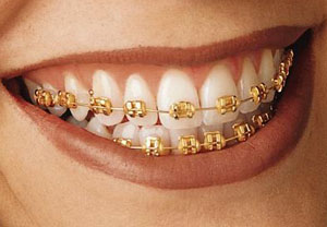 braces