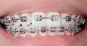 Braces close ups