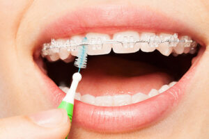 brushing braces